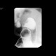 Tumorous stenosis of lienal flexure, severe stenosis, barium enema: RF - Fluoroscopy