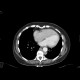Vena cava sinistra, continuation of hemiazygous vein: CT - Computed tomography