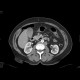 Vena cava sinistra, continuation of hemiazygous vein: CT - Computed tomography