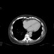 Vena cava sinistra, continuation of hemiazygous vein: CT - Computed tomography