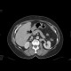 Vena cava sinistra, continuation of hemiazygous vein: CT - Computed tomography