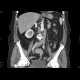Vena cava sinistra, continuation of hemiazygous vein: CT - Computed tomography