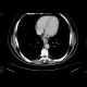 Carcinoma of oesophagus, tumorous stenosis: CT - Computed tomography