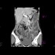 Volvulus, torsion of ileum, ileus: CT - Computed tomography