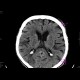 Ischemia, temporal lobe, first CT: CT - Computed tomography