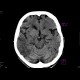 Ischemia, temporal lobe, second CT: CT - Computed tomography