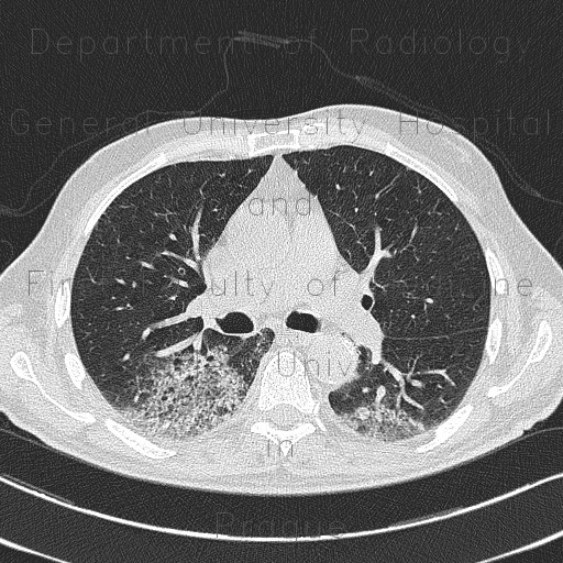 ANCA vasculitis, lung involvement