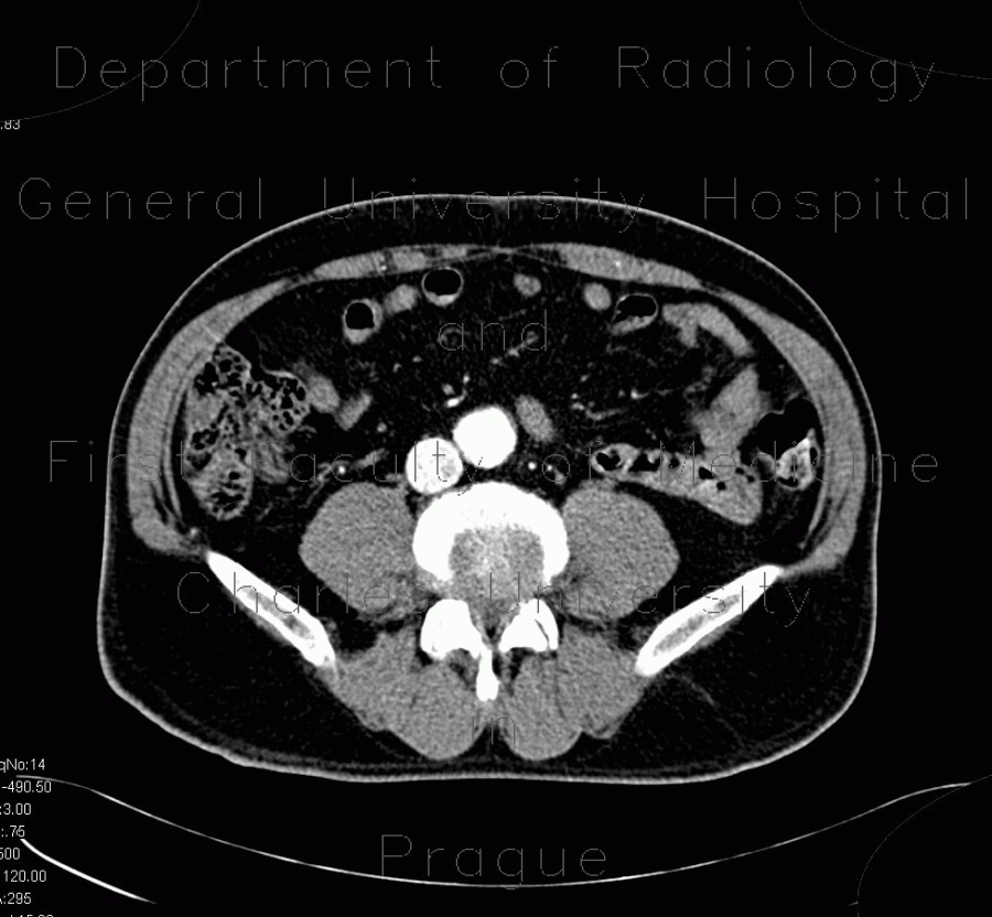 AV fistula, arteriovenous fistula in the leg