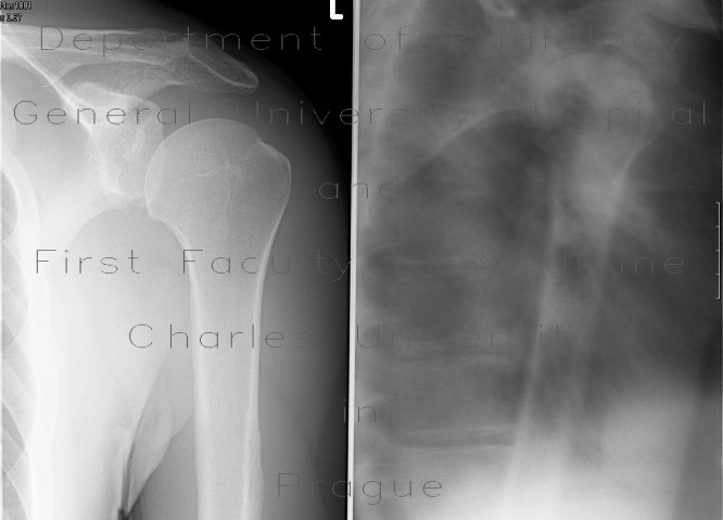 Abruption of the rim of glenoid