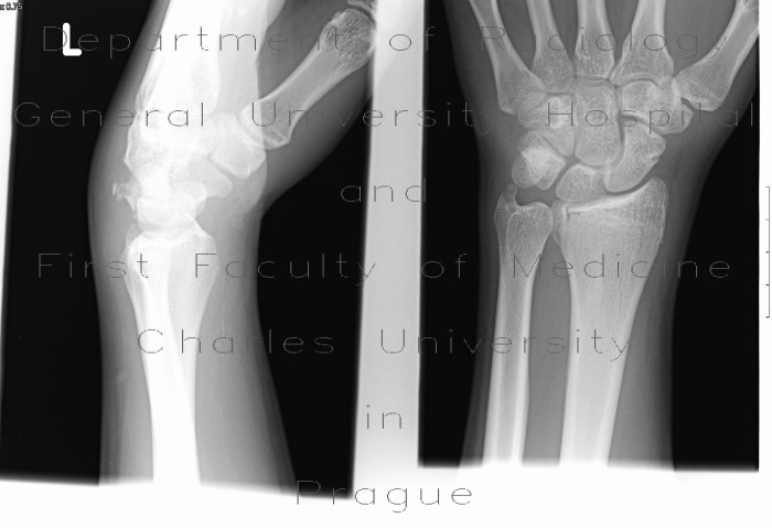 Abruption of triquetrum, transverse fracture of distal radius, abruption of unlar styloid process