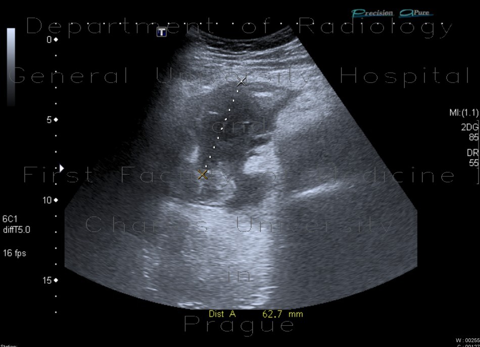 Abscess, Crohn's disease, intra-abdominal abscess