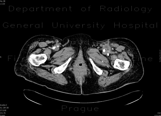 Abscess at the proximal anastomosis of aorto-femoral bypass