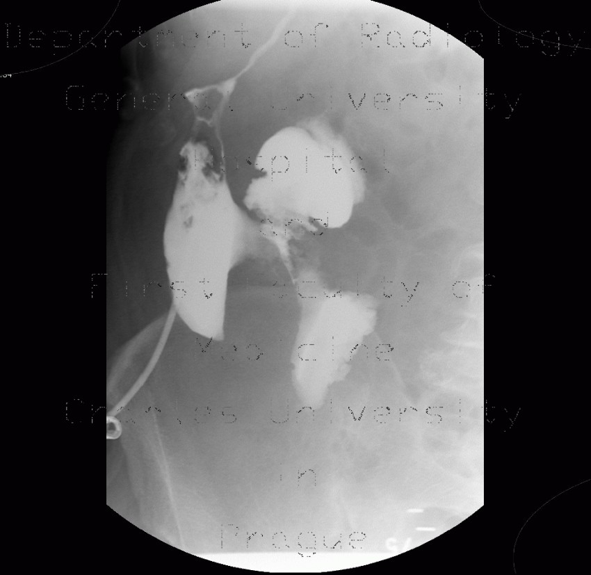 Abscess, cutaneous fistula, colonic fistula