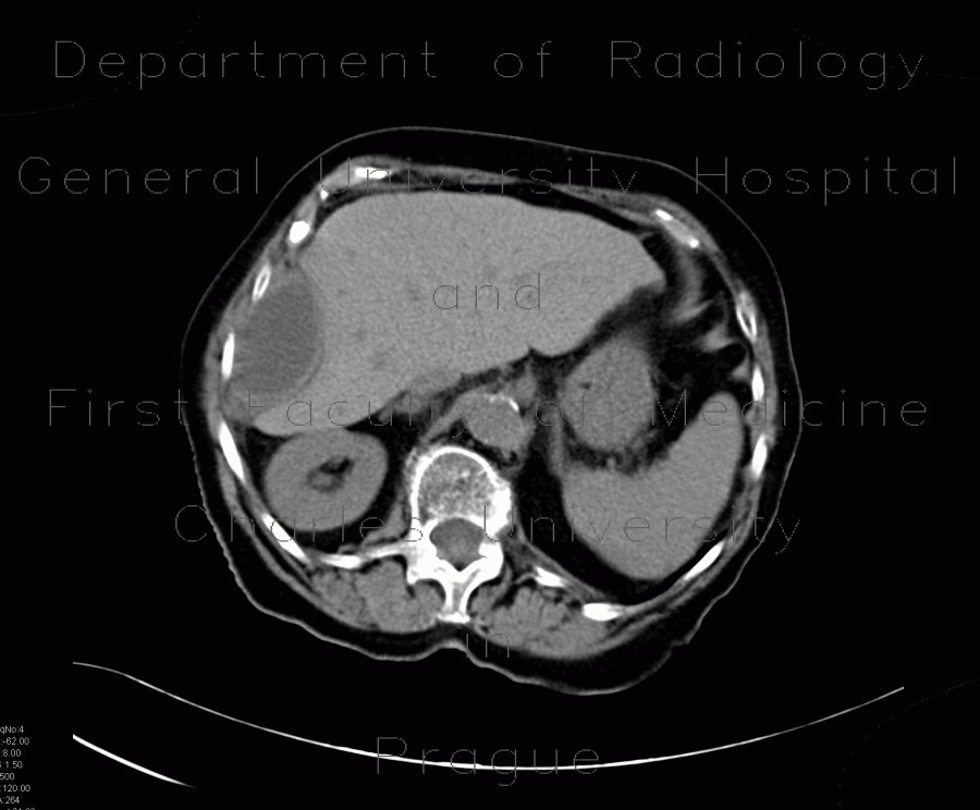 Abscess, perihepatic abscess, drainage, pig-tail