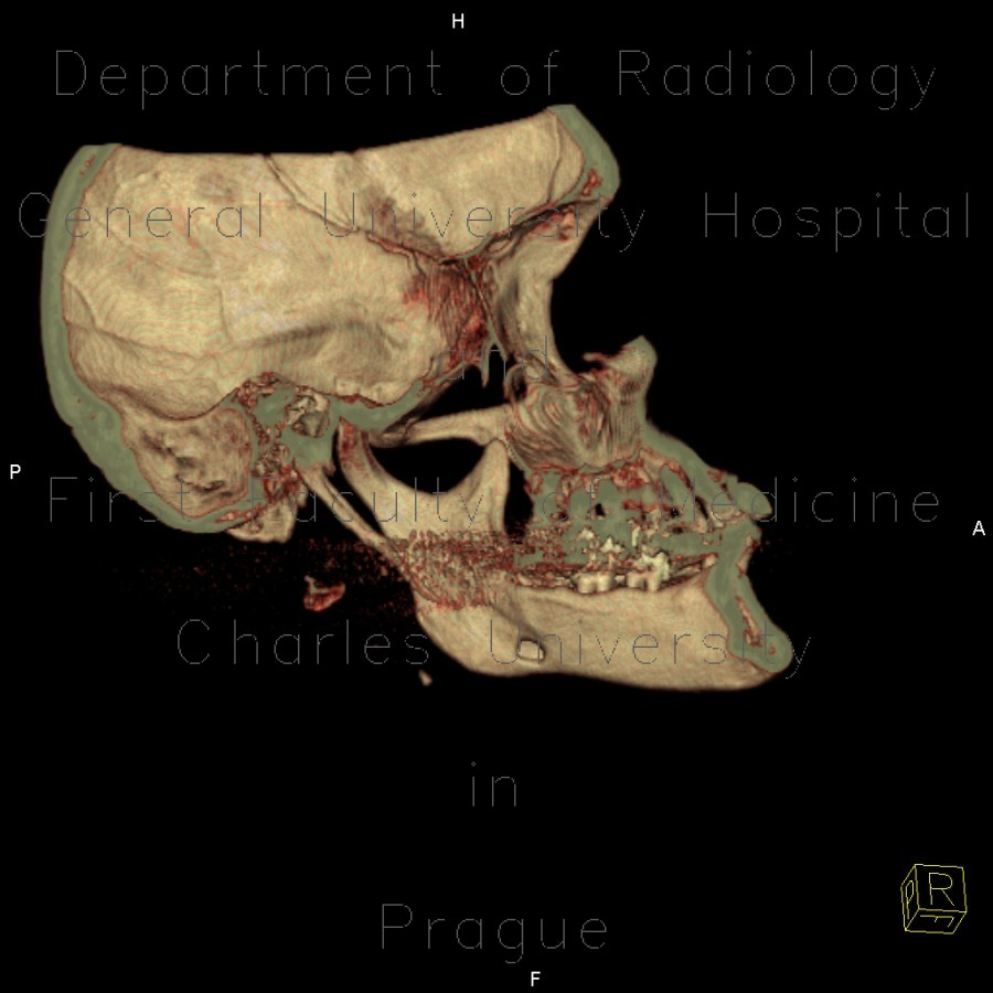 Accessory salivary gland, Stafne's defect, VRT