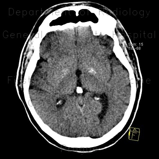 Accumulation of iron in the medial globus pallidus, globus pallidus internus