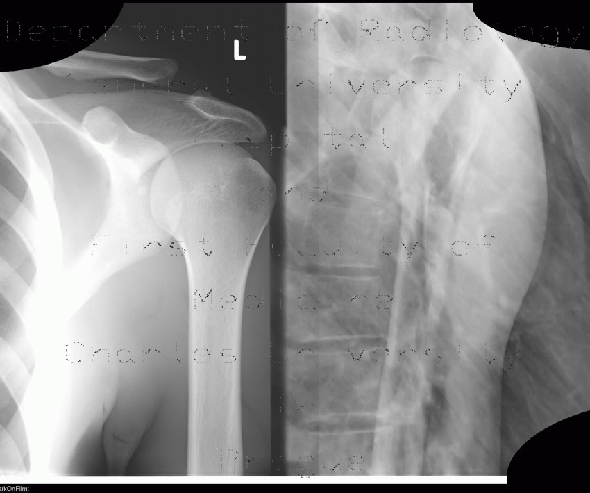 Acromioclavicular joint, separation