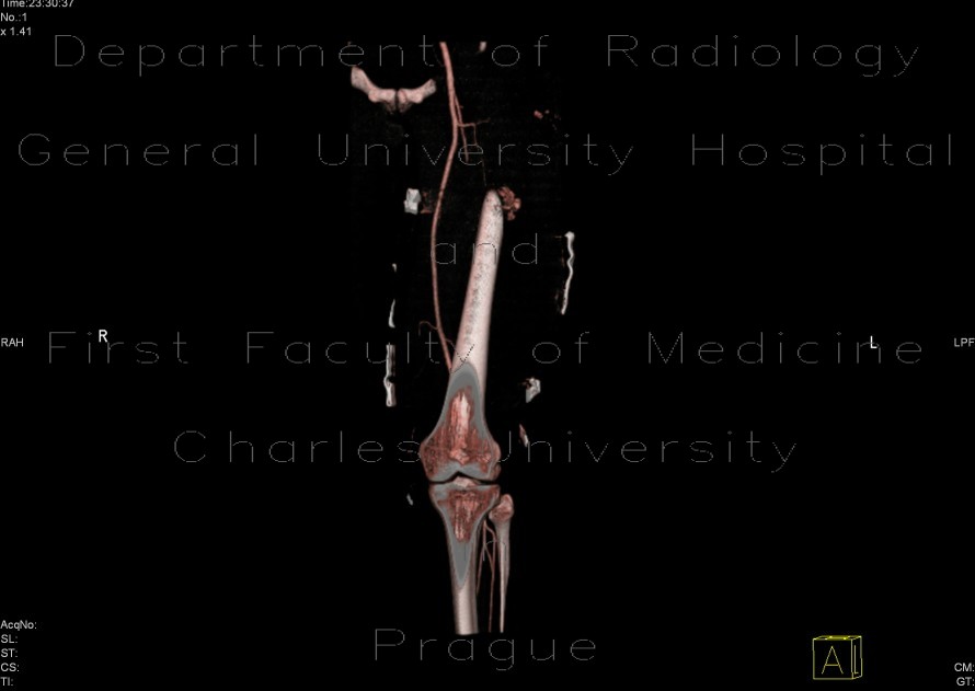 Active bleeding in the thigh