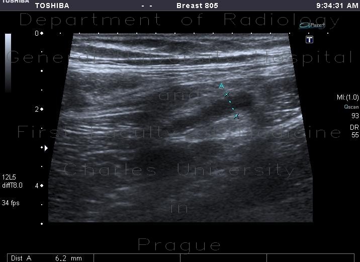 Acute appendicitis