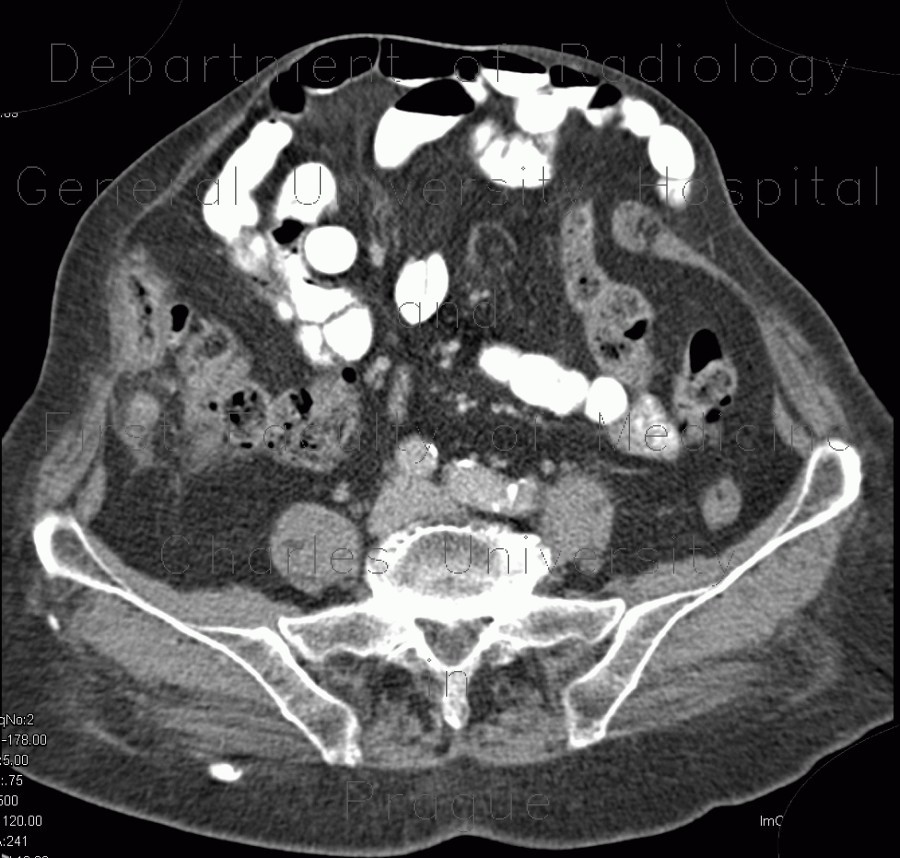 Acute appendicitis