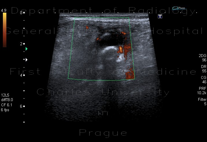 Acute appendicitis, appendicolith
