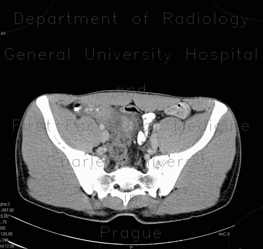 Acute appendicitis, periappendiceal infiltrate