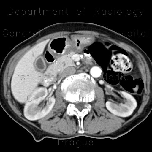 Acute cholecystitis