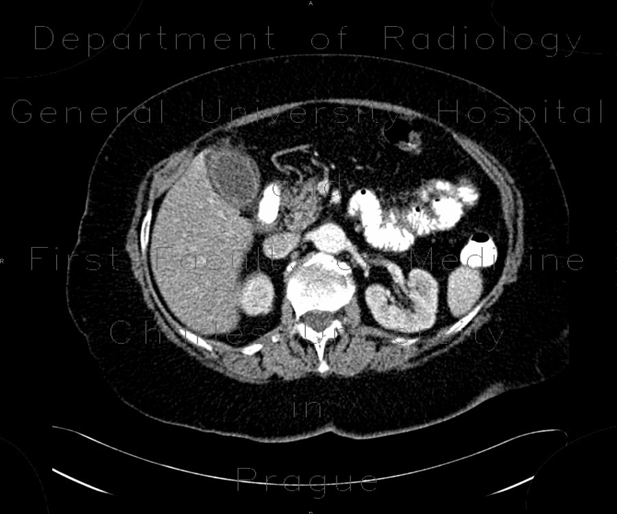 Acute cholecystitis, CT