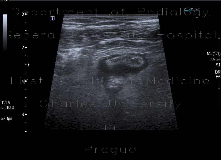 Acute diverticulitis on ultrasound