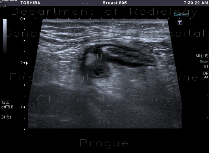 Acute diverticulitis, peridiverticulitis, sigmoid colon