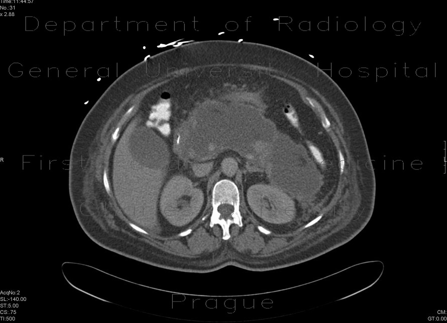 Acute necrosing pancreatitis