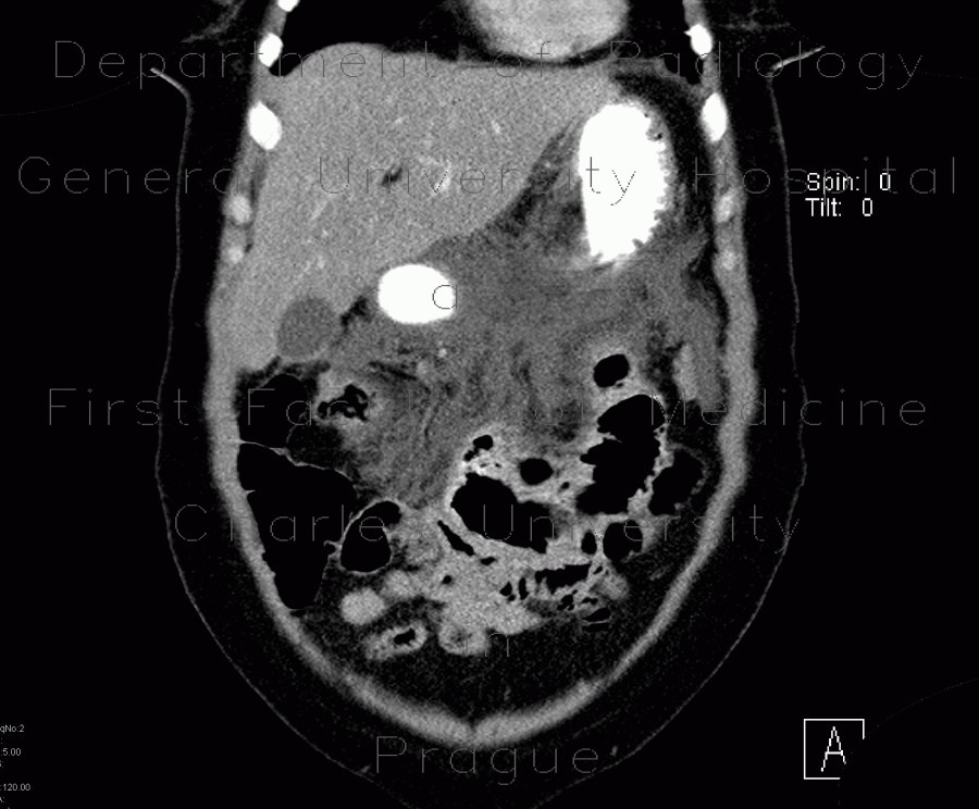 Acute pancreatitis, chylous pancreatitis, hypertriglyceridemia-associated acute pancreatitis