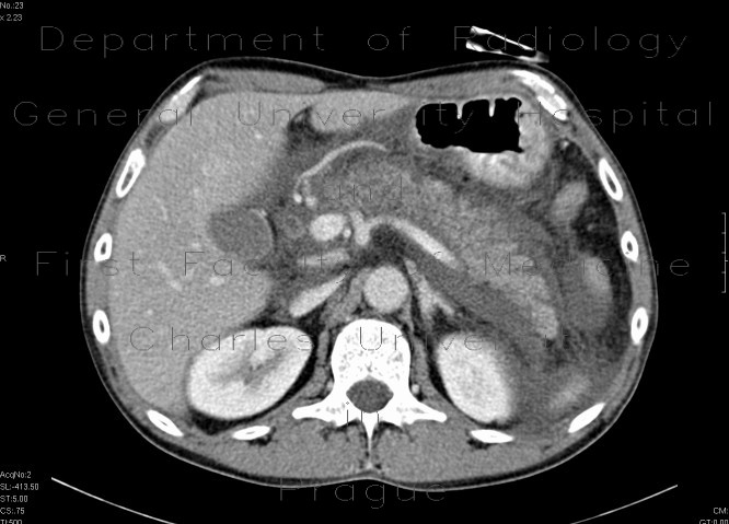Acute pancreatitis, exsudative stage