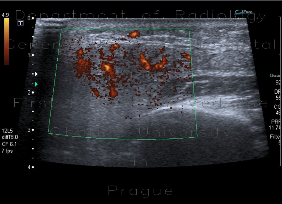 Acute parotitis