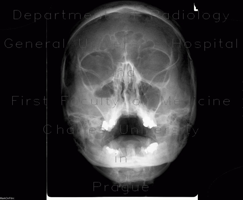 Acute sinusitis, Waters view