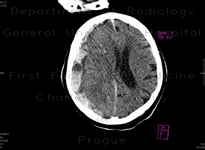 Acute subdural hemorrhage, active bleeding
