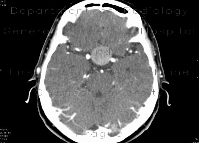 Adenoma of hypophysis, before and after resection