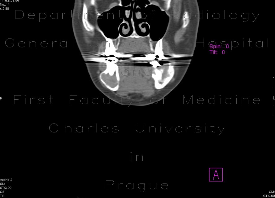 Adenoma of parathyroid gland, brown tumours