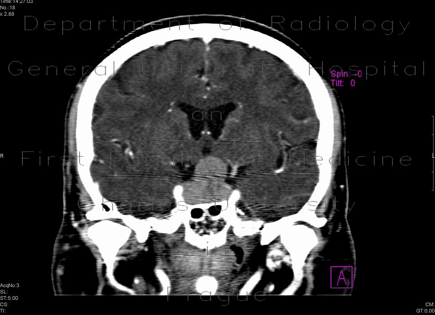 Adenoma of the hypophysis