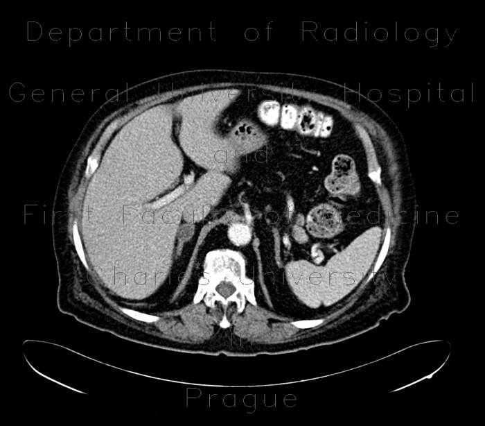Adrenal adenoma