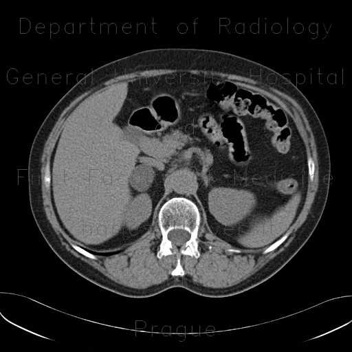 Adrenal adenoma, unenhanced