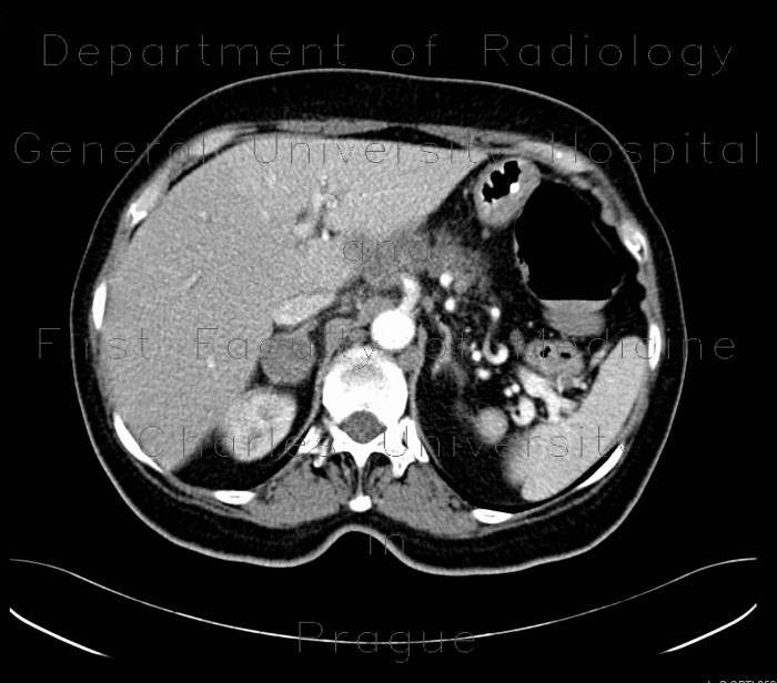 Adrenal metastasis