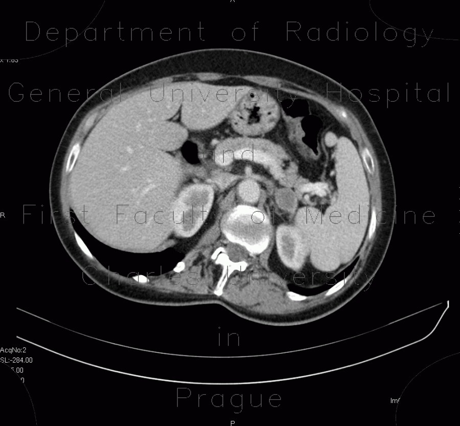 Adrenal metastasis and skeletal metastasis of pulmonary carcinoma, correlation