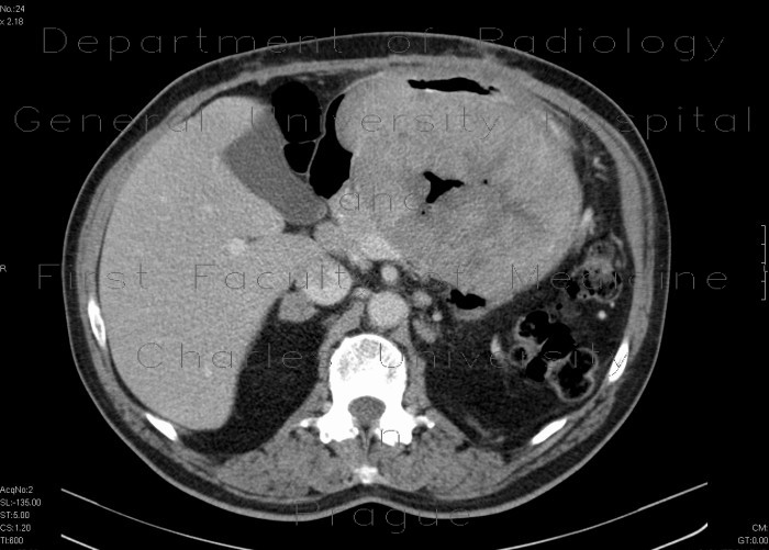 Adrenal tumour, extensive