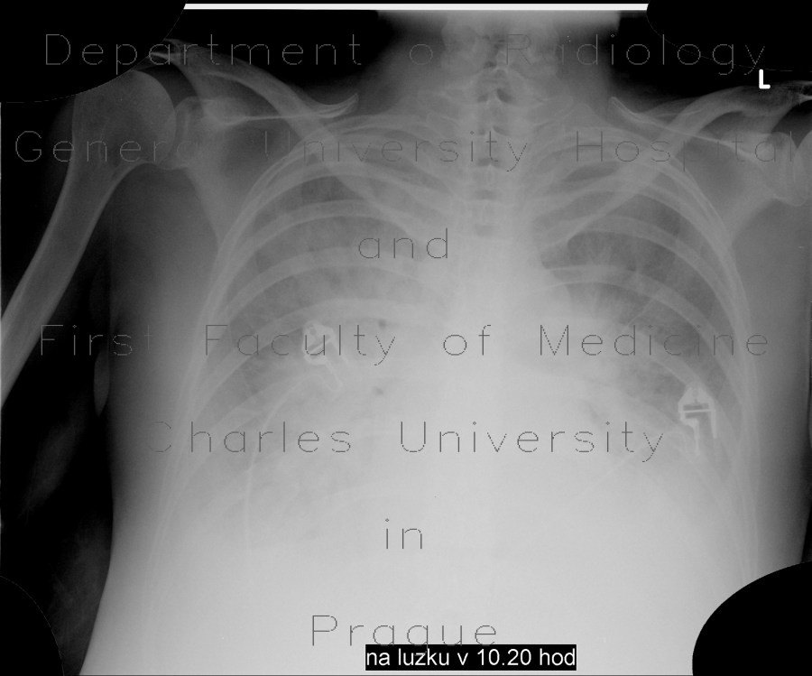 Alveolar pulmonary edema