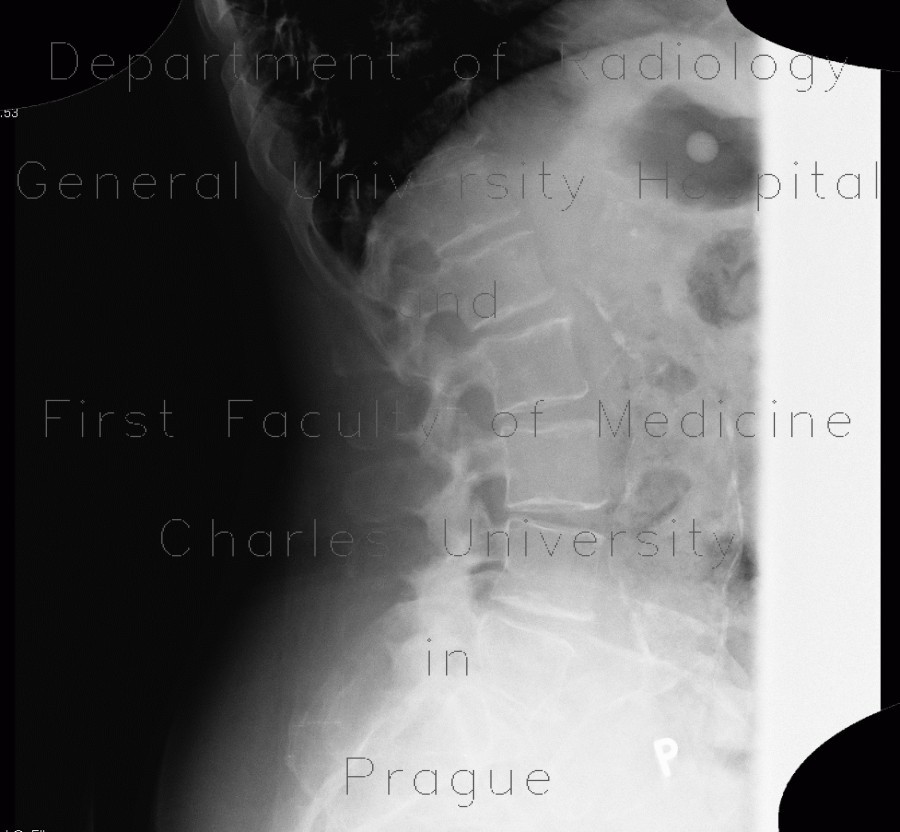 Aneurysm of abdominal aorta on plain radiograph, stent