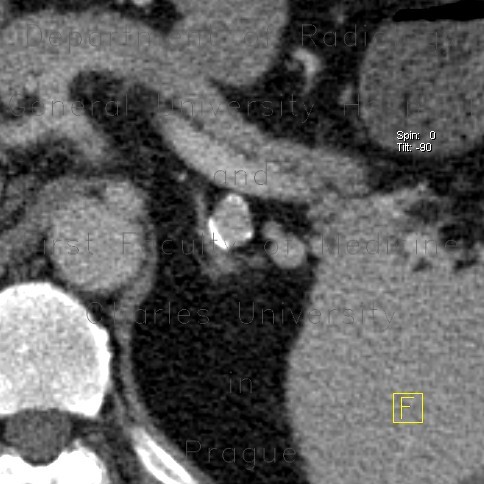 Aneurysm of lienal artery