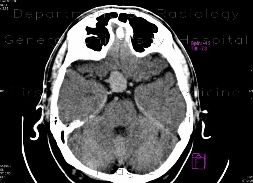 Aneurysm of the internal carotid artery - non-enhanced