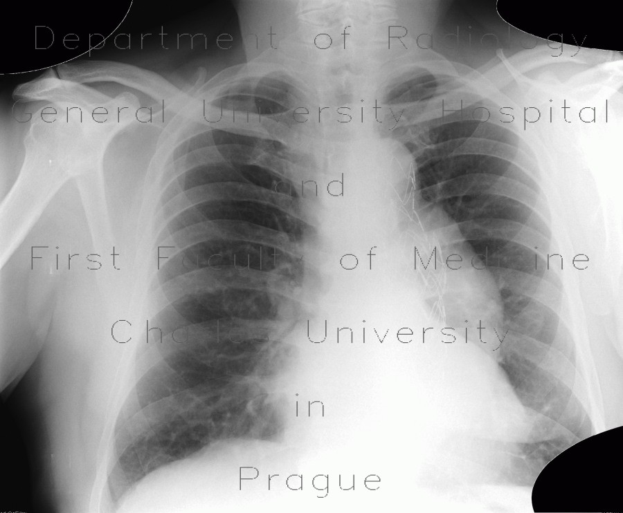 Aneurysm of thoracic aorta on chest radiograph