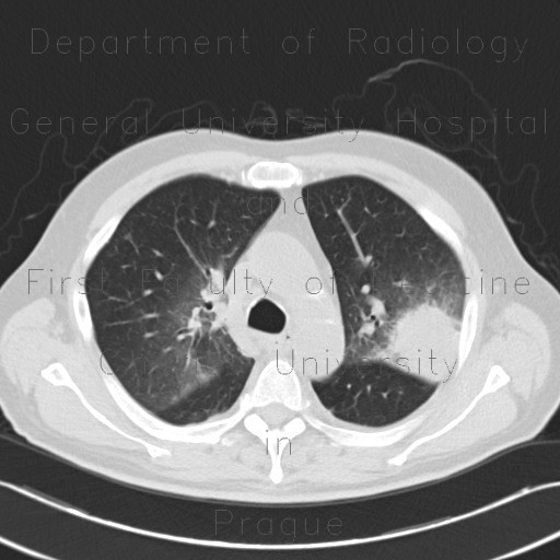 Angioinvasive aspergilosis